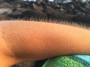 goosebumps, cold, arm, goosebumps, goosebumps, goosebumps, goosebumps, goosebumps